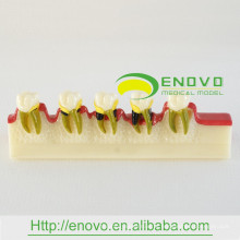 EN-M8 Modelo de desenvolvimento de doença dentária / modelo de doença dentária